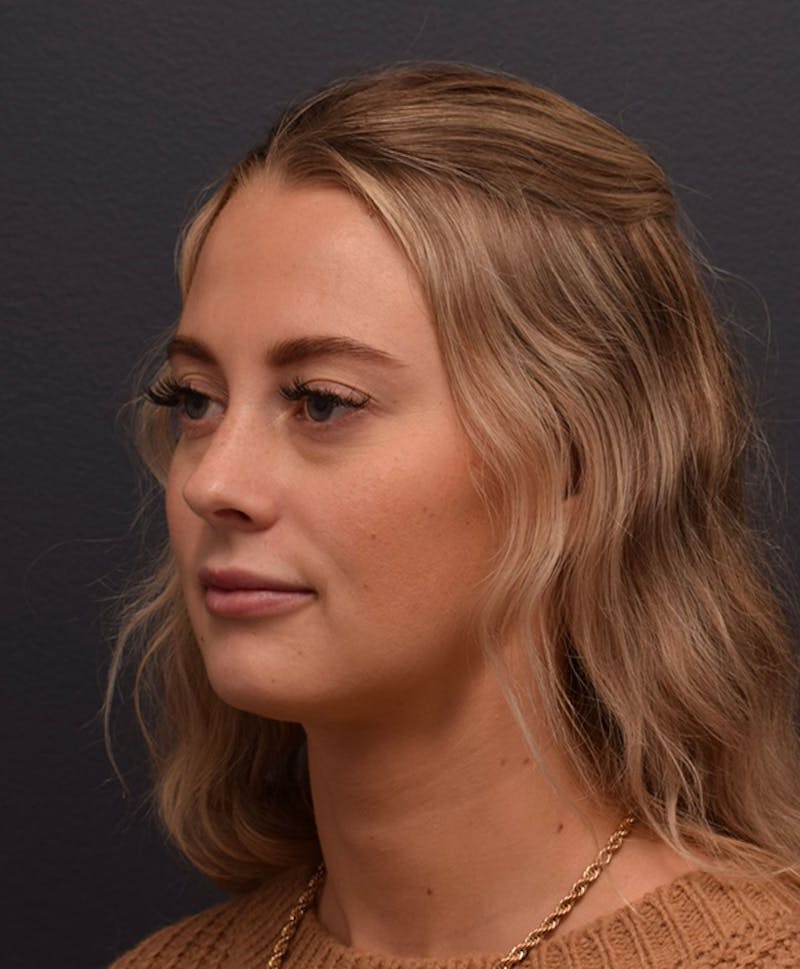 Face Before & After Gallery - Patient 63360549 - Image 6