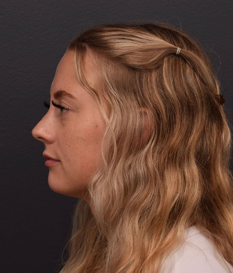 Face Before & After Gallery - Patient 63360549 - Image 7