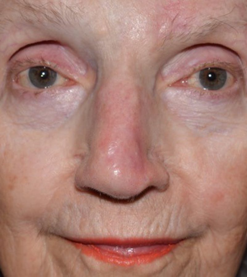 Facial Reconstruction Before & After Gallery - Patient 63360548 - Image 2