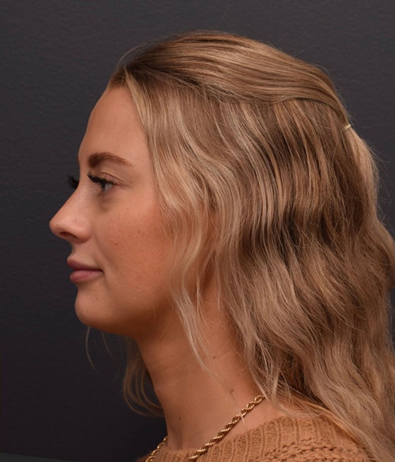 Face Before & After Gallery - Patient 63360549 - Image 8