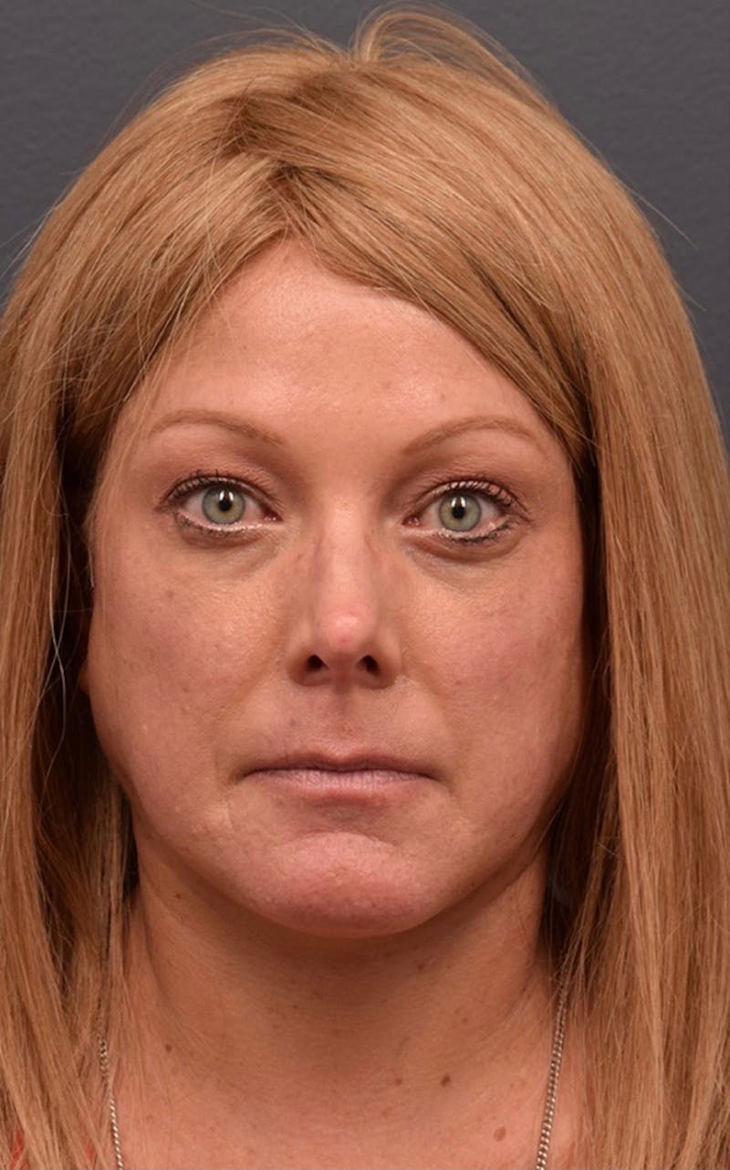 Face Before & After Gallery - Patient 63360556 - Image 1