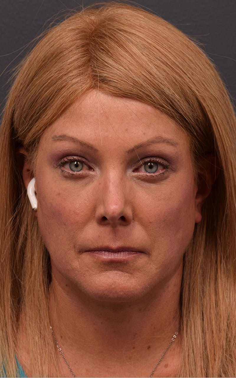 Face Before & After Gallery - Patient 63360556 - Image 2