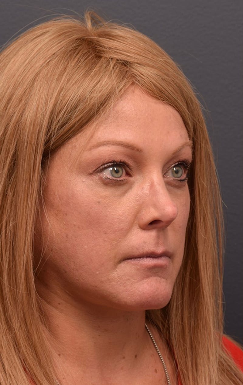 Face Before & After Gallery - Patient 63360556 - Image 3