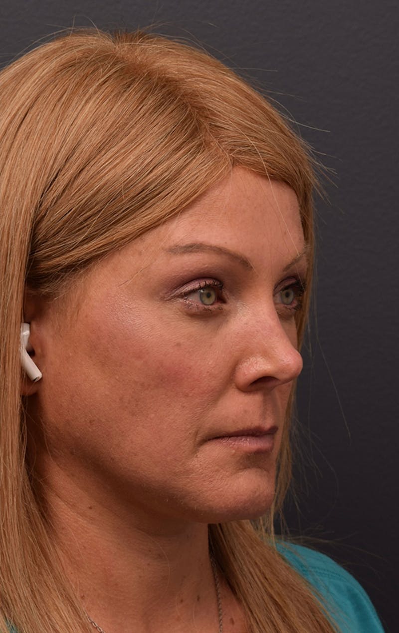 Face Before & After Gallery - Patient 63360556 - Image 4