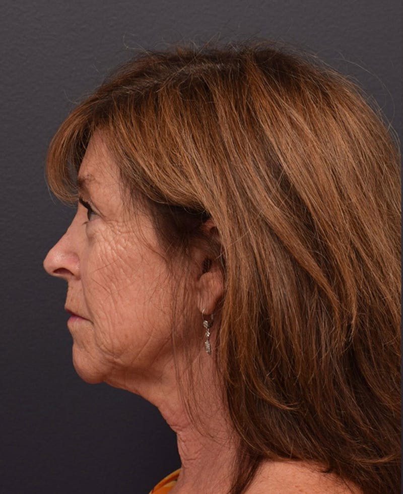 Non-Surgical Before & After Gallery - Patient 63360552 - Image 9