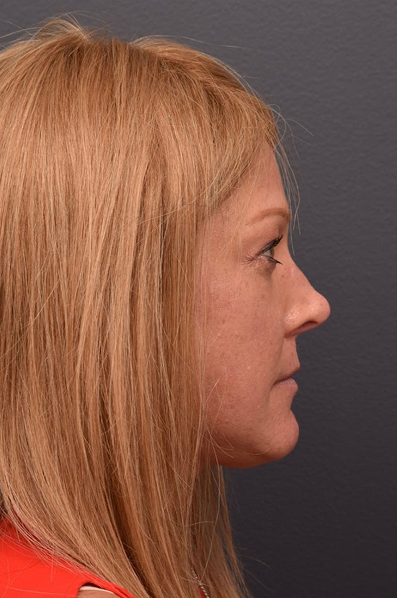 Face Before & After Gallery - Patient 63360556 - Image 5