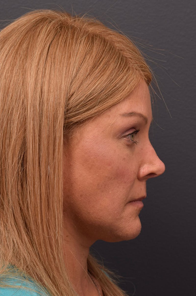 Cosmetic Surgical Before & After Gallery - Patient 63360556 - Image 6