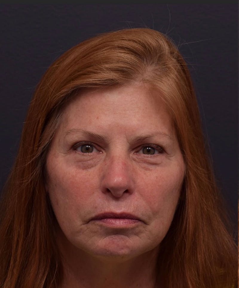 Face Before & After Gallery - Patient 172662 - Image 1