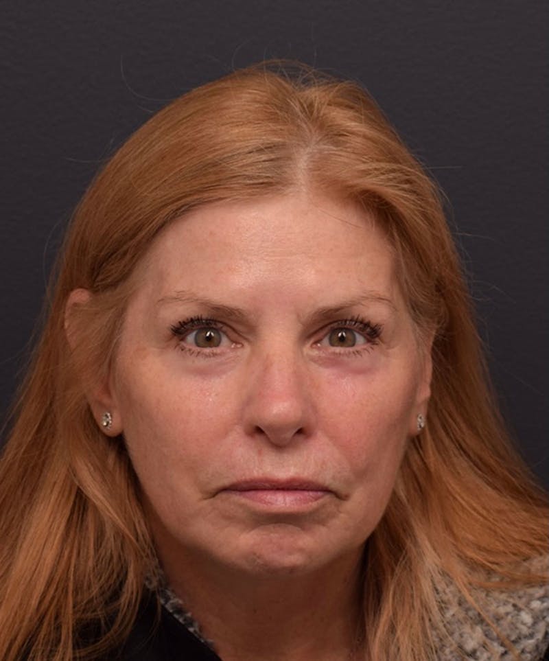 Face Before & After Gallery - Patient 172662 - Image 2