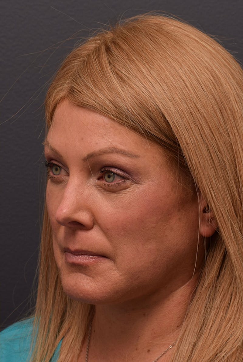 Face Before & After Gallery - Patient 63360556 - Image 8