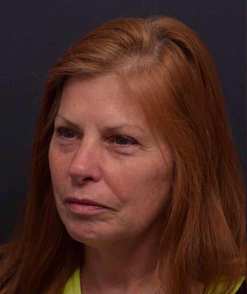 Face Before & After Gallery - Patient 172662 - Image 3