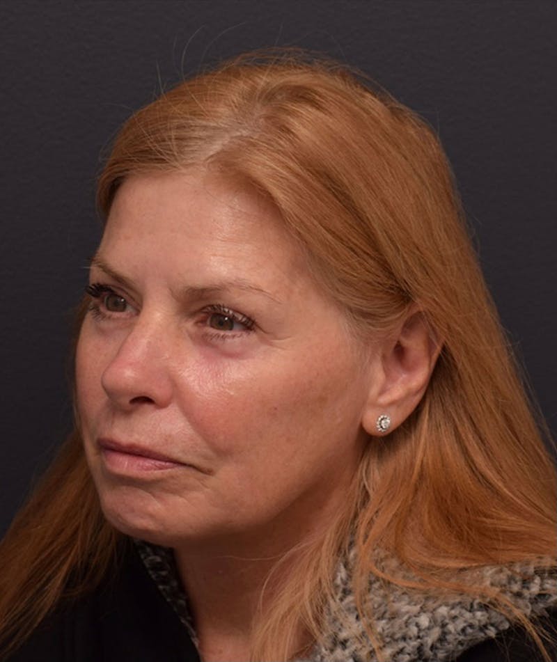 Face Before & After Gallery - Patient 172662 - Image 4