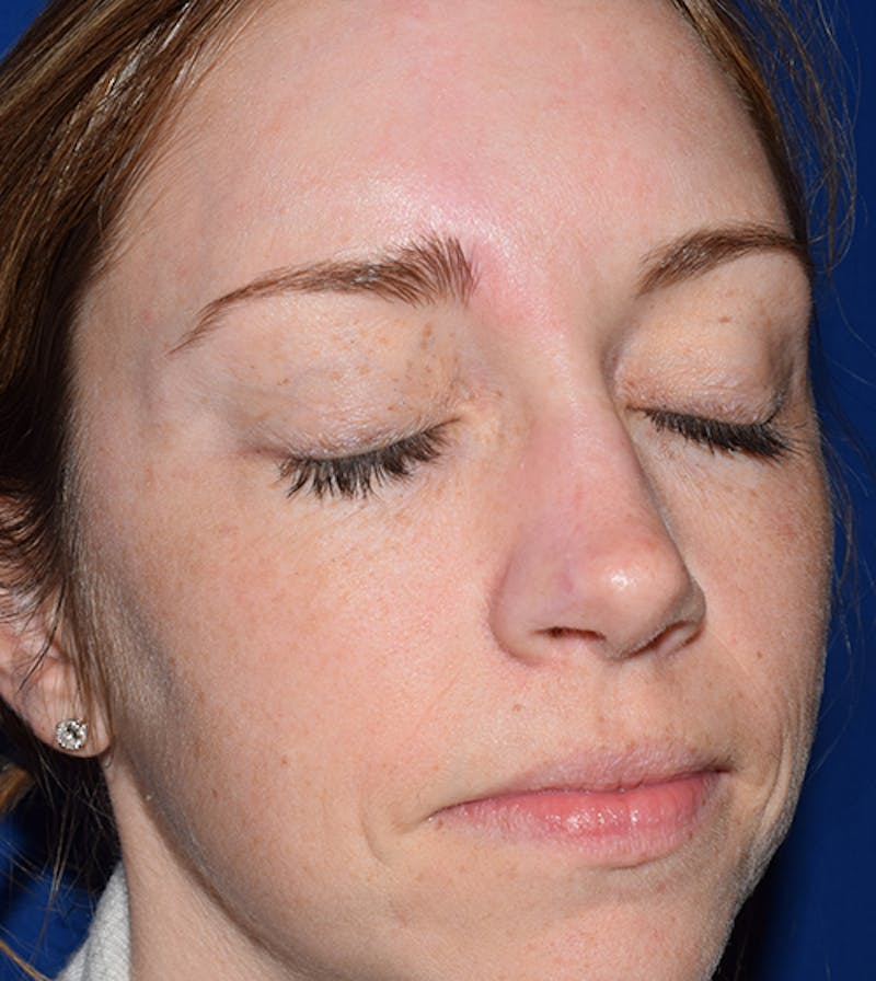 Facial Reconstruction Before & After Gallery - Patient 63360559 - Image 2