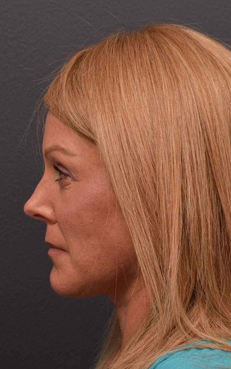 Cosmetic Surgical Before & After Gallery - Patient 63360556 - Image 10
