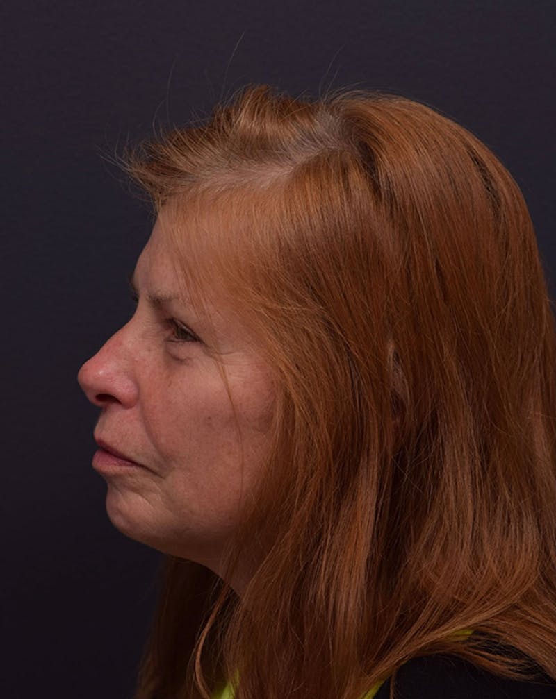 Face Before & After Gallery - Patient 172662 - Image 5