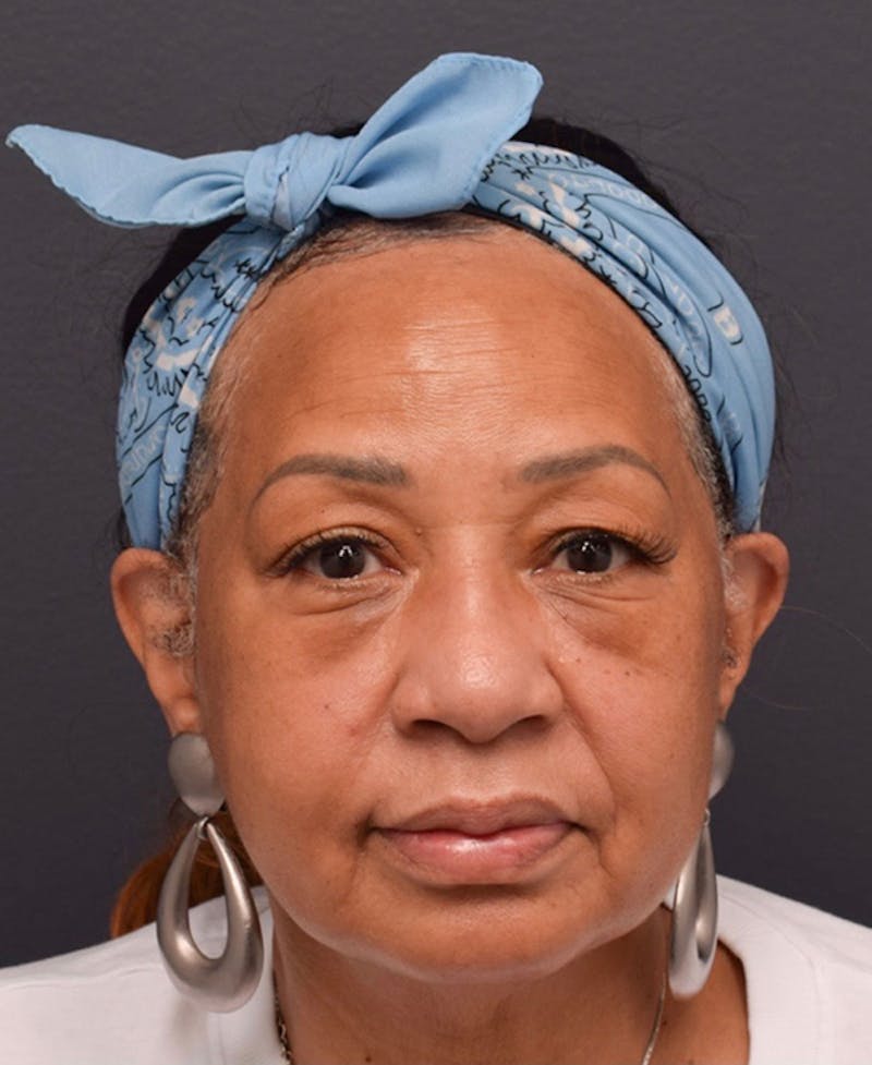 Face Before & After Gallery - Patient 63360561 - Image 1