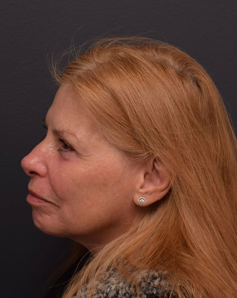 Cosmetic Non-Surgical Before & After Gallery - Patient 63360557 - Image 6