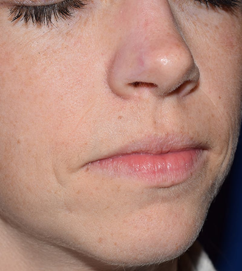 Facial Reconstruction Before & After Gallery - Patient 63360559 - Image 4