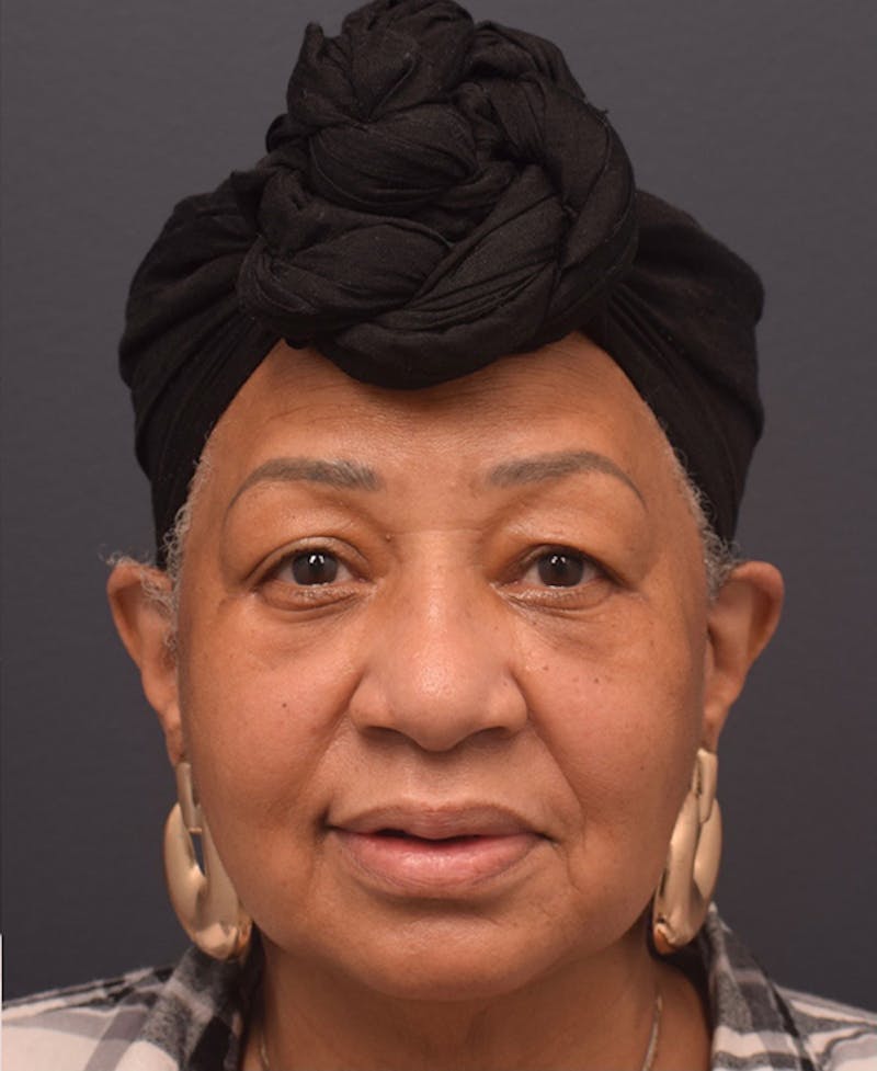 Face Before & After Gallery - Patient 63360561 - Image 2