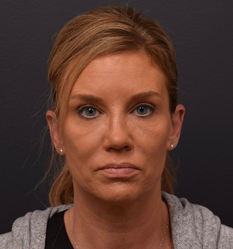 Face Before & After Gallery - Patient 346253 - Image 1