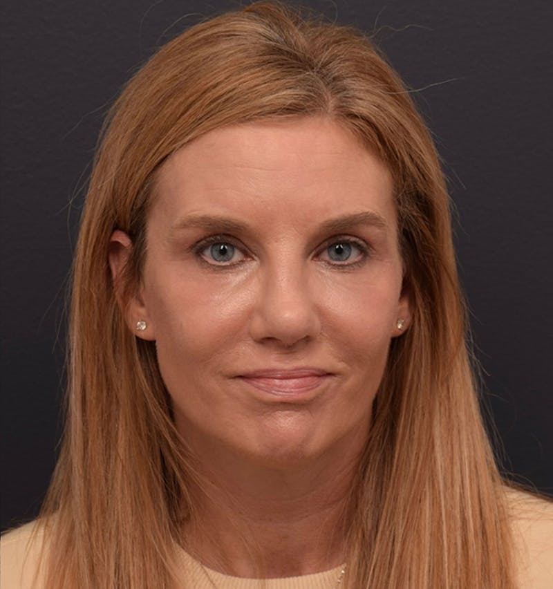 Face Before & After Gallery - Patient 346253 - Image 2