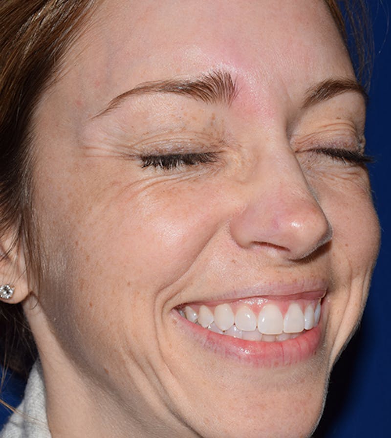 Facial Reconstruction Before & After Gallery - Patient 63360559 - Image 6