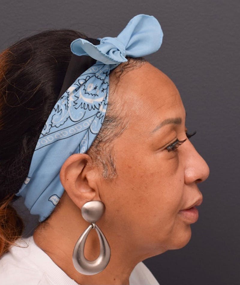 Face Before & After Gallery - Patient 63360561 - Image 5