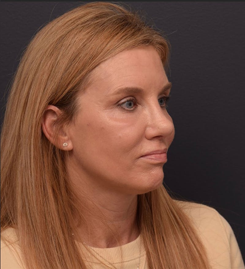 Face Before & After Gallery - Patient 346253 - Image 4