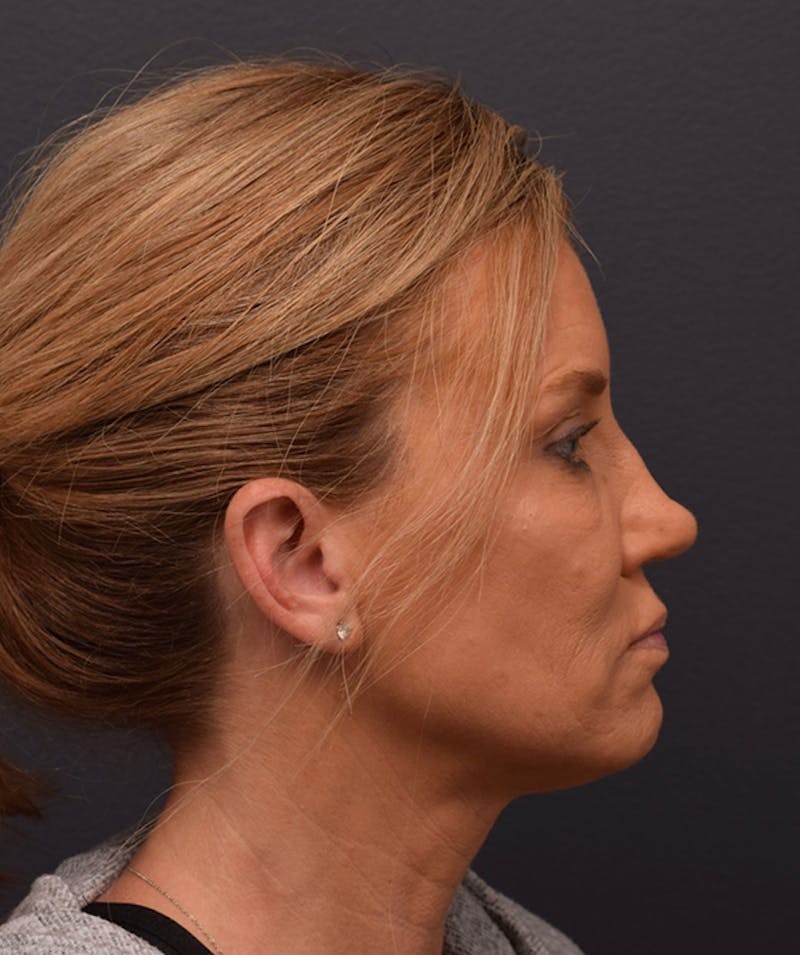 Face Before & After Gallery - Patient 346253 - Image 5