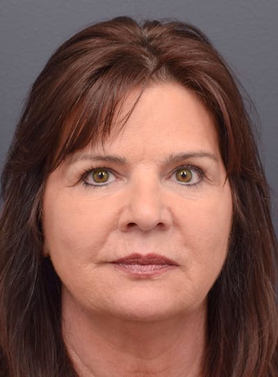 Cosmetic Surgical Before & After Gallery - Patient 63360567 - Image 1