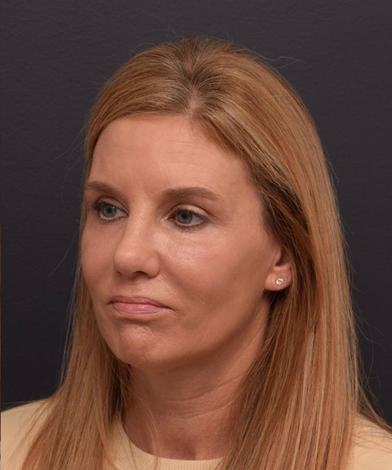 Face Before & After Gallery - Patient 346253 - Image 8