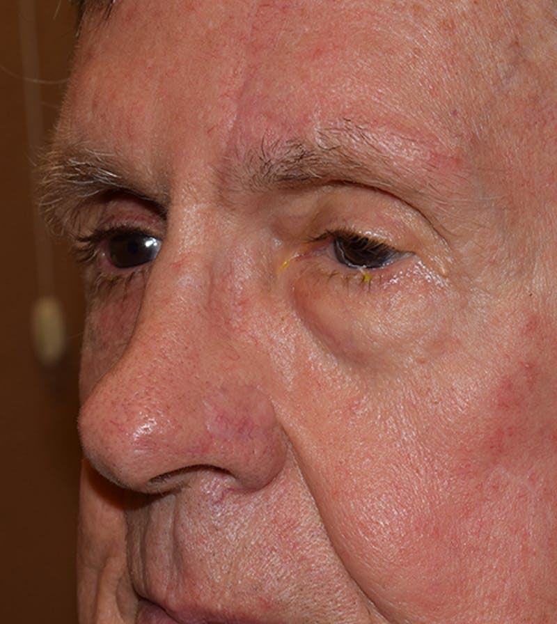 Facial Reconstruction Before & After Gallery - Patient 63360563 - Image 4