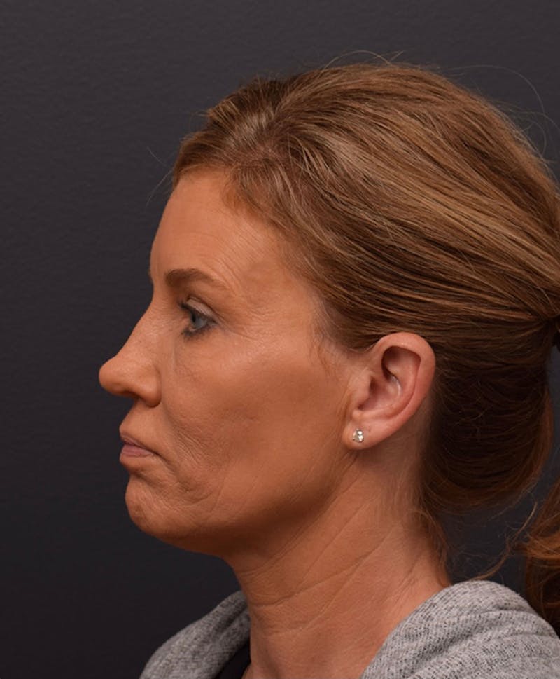 Face Before & After Gallery - Patient 346253 - Image 9
