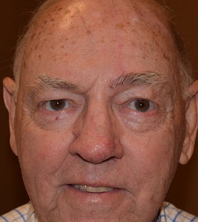 Facial Reconstruction Before & After Gallery - Patient 63360568 - Image 2