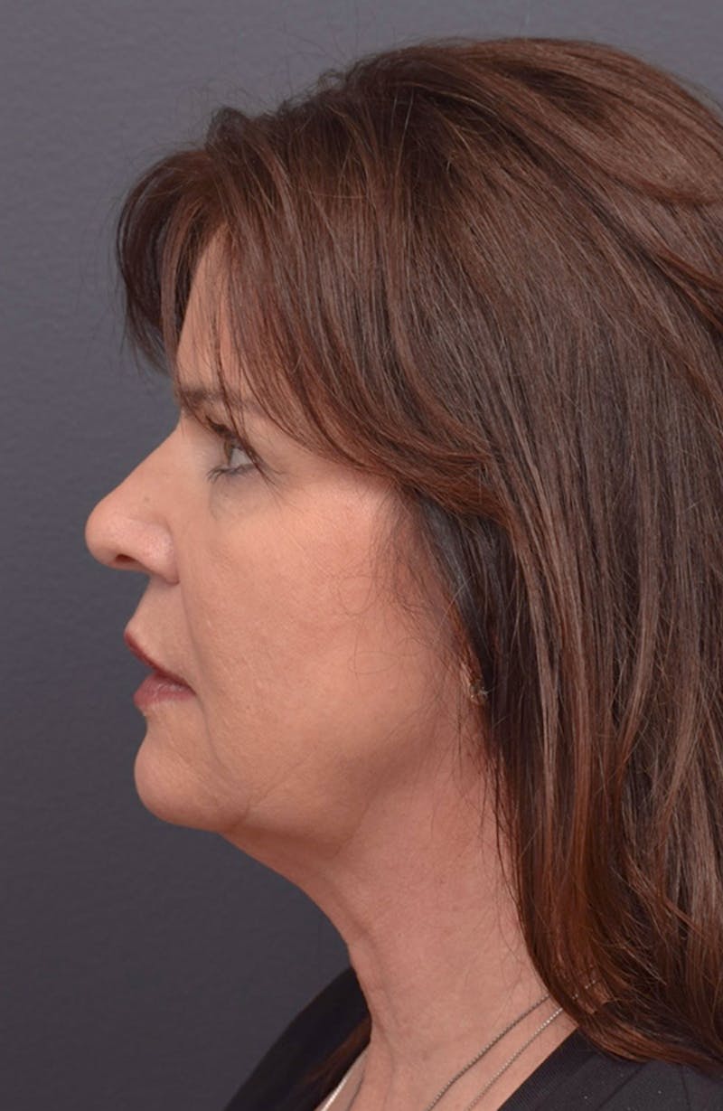 Face Before & After Gallery - Patient 63360567 - Image 5