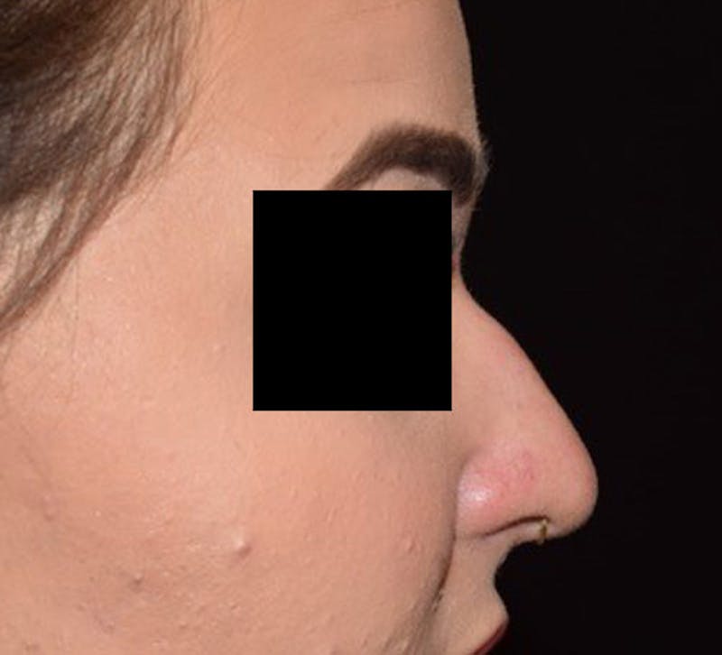 Non-Surgical Before & After Gallery - Patient 63360569 - Image 1