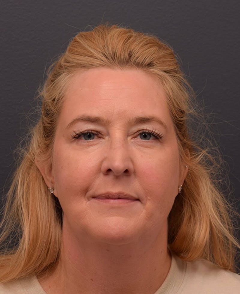 Face Before & After Gallery - Patient 63360573 - Image 1