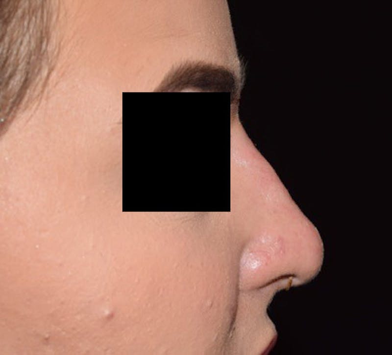 Non-Surgical Before & After Gallery - Patient 63360569 - Image 2