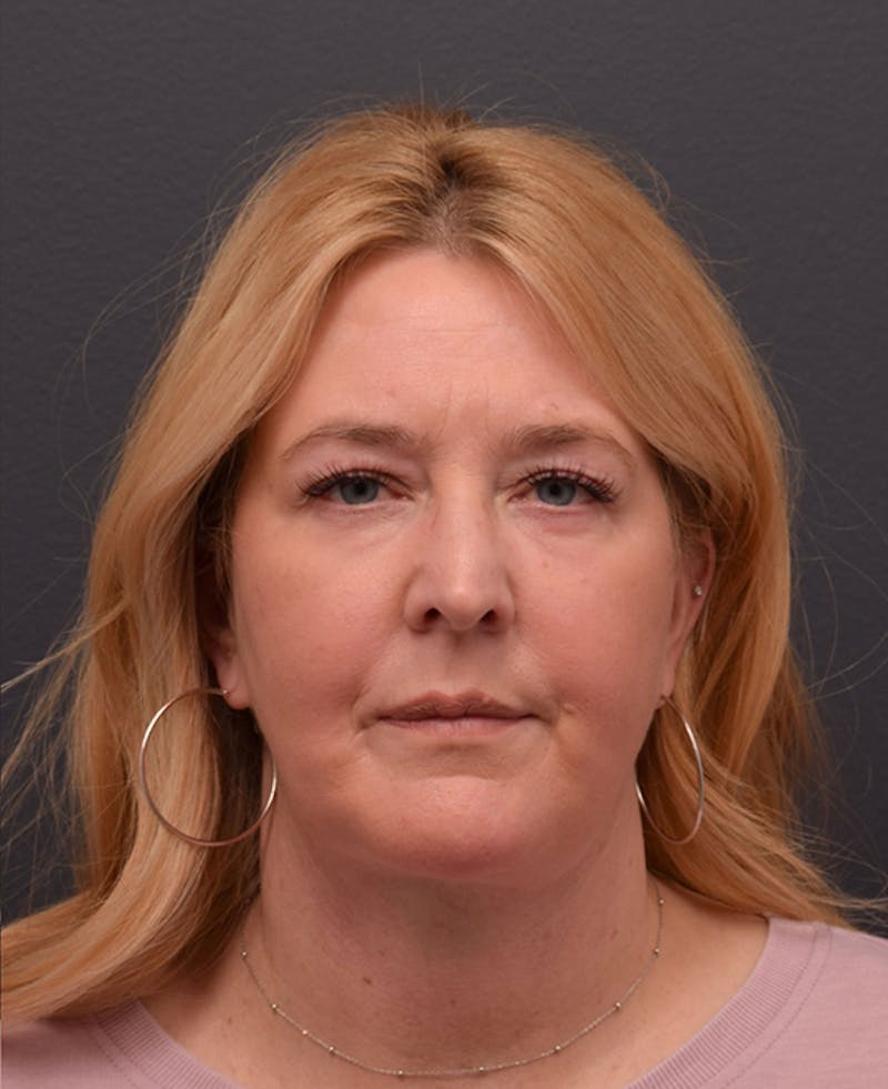 Face Before & After Gallery - Patient 63360573 - Image 2