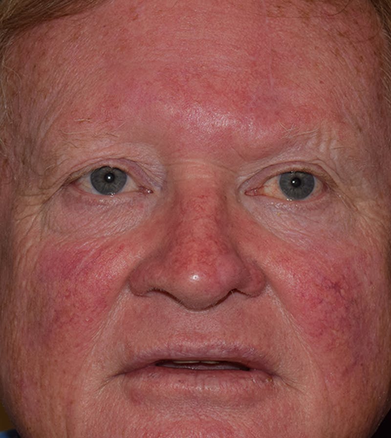 Facial Reconstruction Before & After Gallery - Patient 63360570 - Image 2