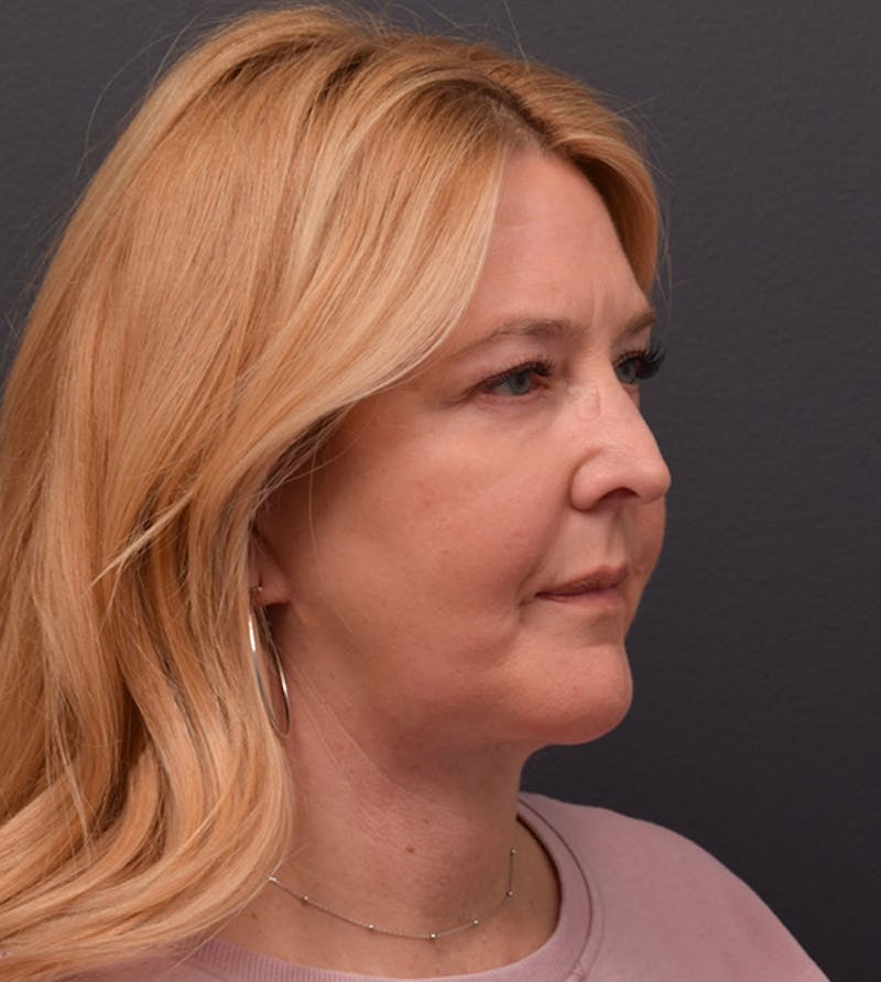 Face Before & After Gallery - Patient 63360573 - Image 4