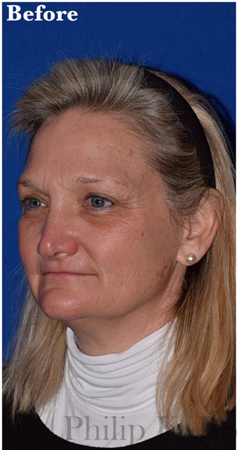 Non-Surgical Before & After Gallery - Patient 63360571 - Image 3