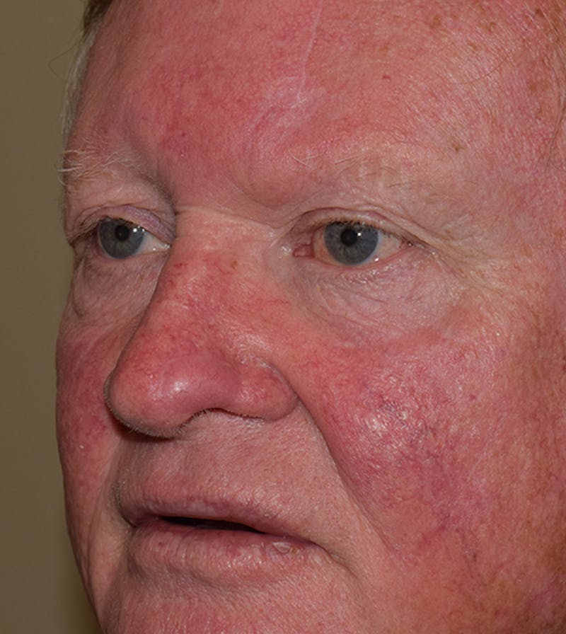 Facial Reconstruction Before & After Gallery - Patient 63360570 - Image 4