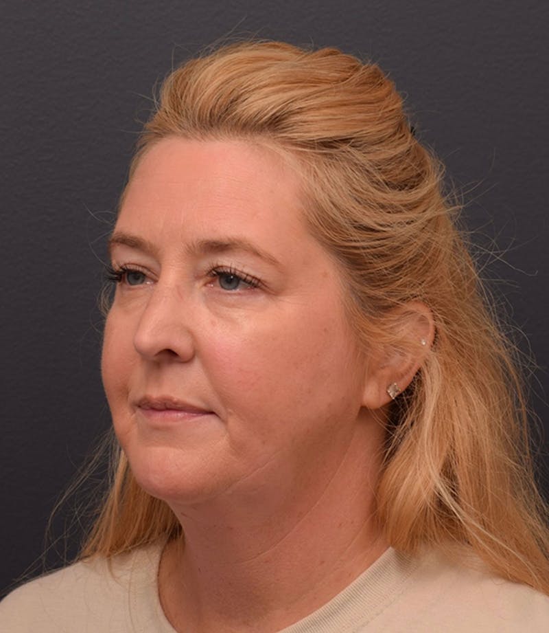Face Before & After Gallery - Patient 63360573 - Image 5
