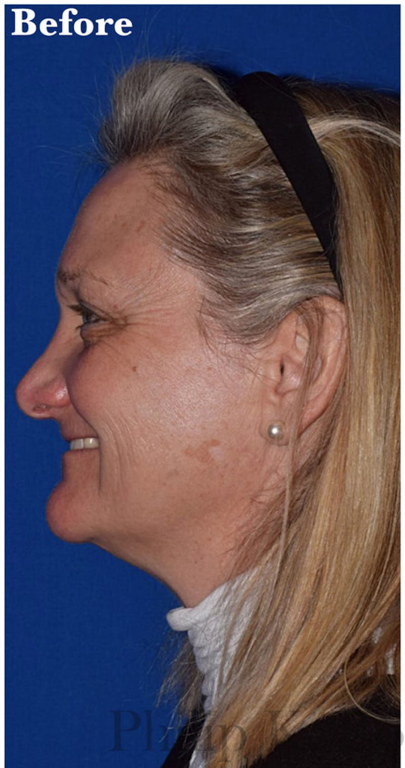 Cosmetic Non-Surgical Before & After Gallery - Patient 63360571 - Image 5