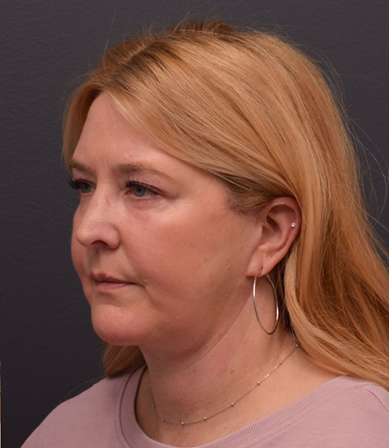 Face Before & After Gallery - Patient 63360573 - Image 6