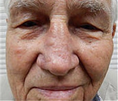 Facial Reconstruction Before & After Gallery - Patient 63360572 - Image 2