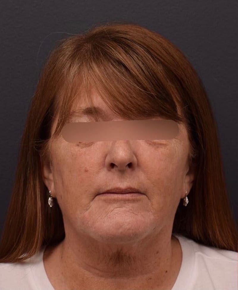 Face Before & After Gallery - Patient 63360581 - Image 1