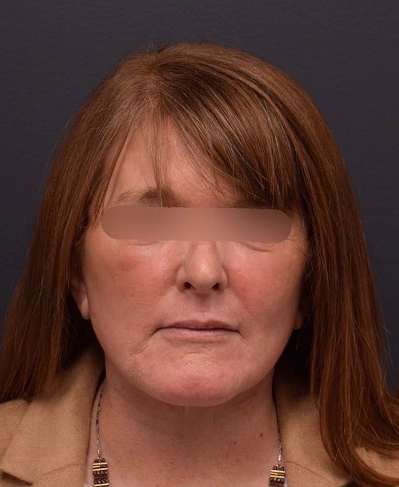 Face Before & After Gallery - Patient 63360581 - Image 2