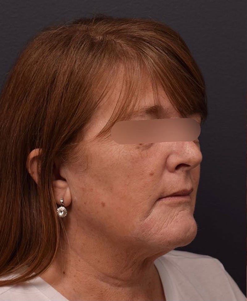 Face Before & After Gallery - Patient 63360581 - Image 3
